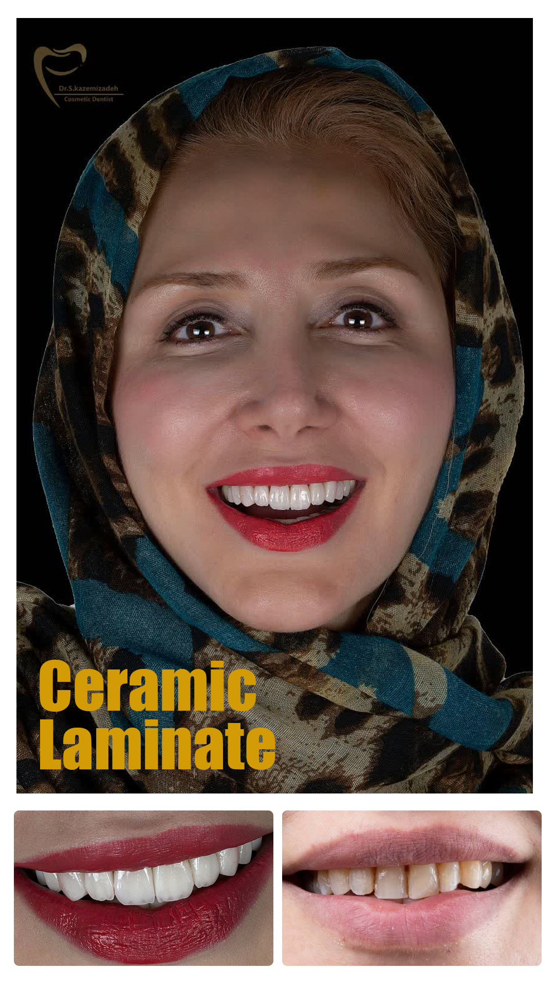 لمینیت سرامیکی در اصفهان