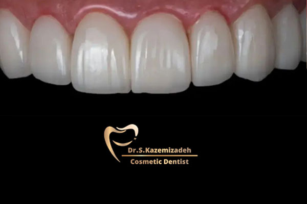 عکس بعد از کامپوزیت دندان توسط دکتر سپیده کاظمی زاده متخصص کامپوزیت دندان در اصفهان