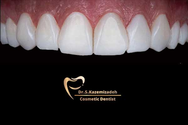 عکس بعد از ونیر کامپوزیت دندان توسط دکتر سپیده کاظمی زاده