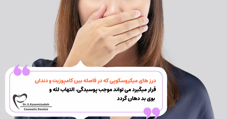 بوی بد دهان بعد از کامپوزیت دندان | کلینیک تخصصی دندان پزشکی دکتر سپیده کاظمی زاده