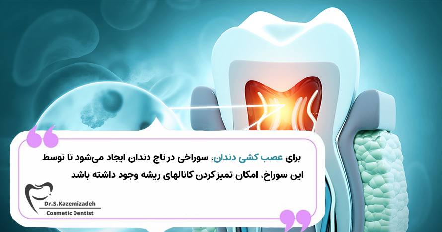 عصب کشی دندان | آیا دندان لمینت شده را می توان عصب کشی کرد؟