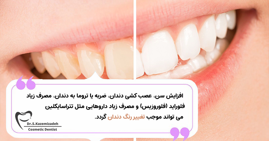 تغییر رنگ دندان | مطب دکتر سپیده کاظمی زاده در اصفهان