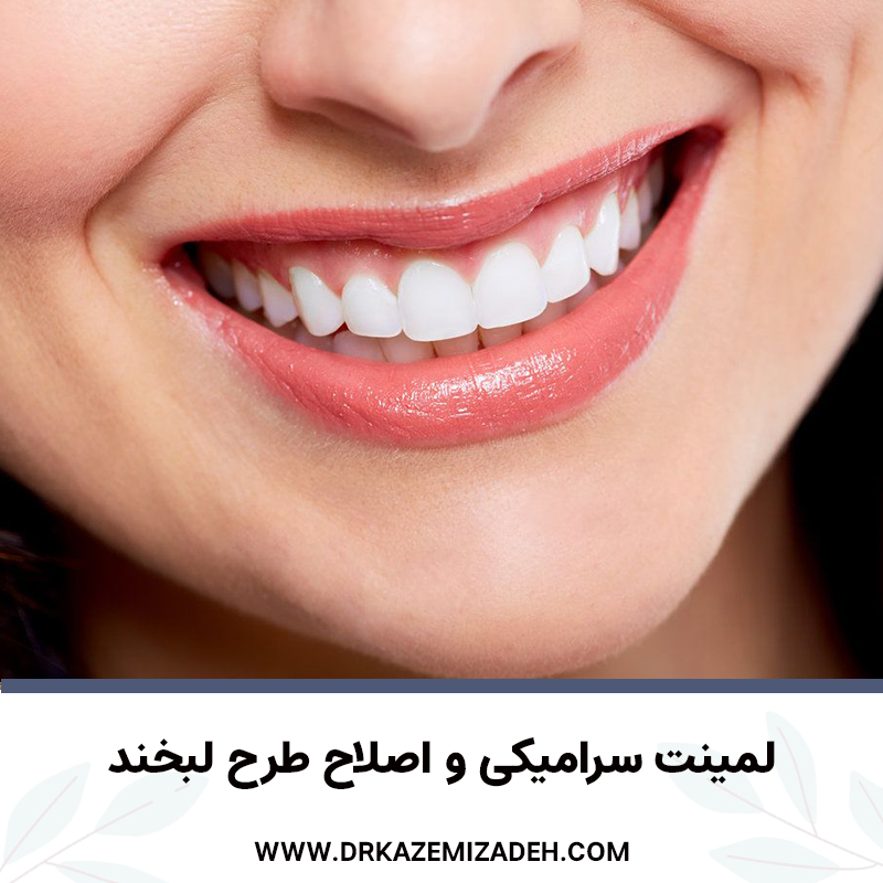 لمینت سرامیکی و اصلاح طرح لبخند | دکتر سپیده کاظمی زاده متخصص دندانپزشکی در اصفهان