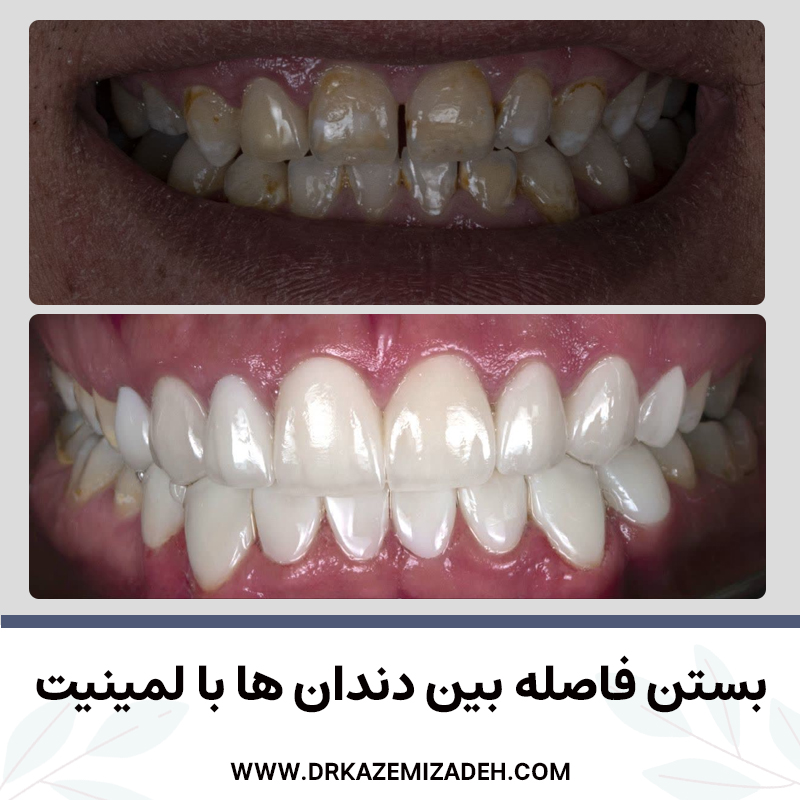 بستن فاصله بین دندان ها با لمینت | مطب دکتر سپیده کاظمی زاده در اصفهان