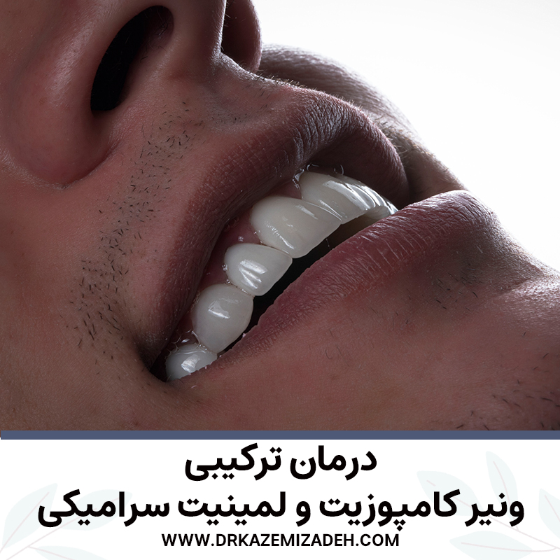درمان ترکیبی لمینیت سرامکی و ونیر کامپوزیت در اصفهان