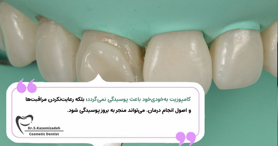 کامپوزیت موجب پوسیدگی دندان می شود؟ | مطب دکتر سپیده کاظمی زاده در اصفهان