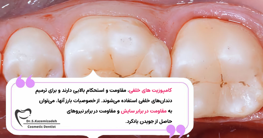کامپوزیت های خلفی | مرکز دندانپزشکی زیبایی دکتر سپیده کاظمی زاده در اصفهان
