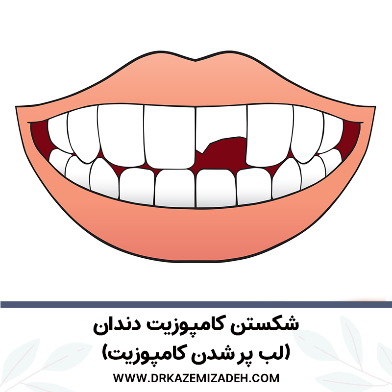 شکستن کامپوزیت دندان | مرکز دندان پزشکی دکتر سپیده کاظمی زاده در اصفهان