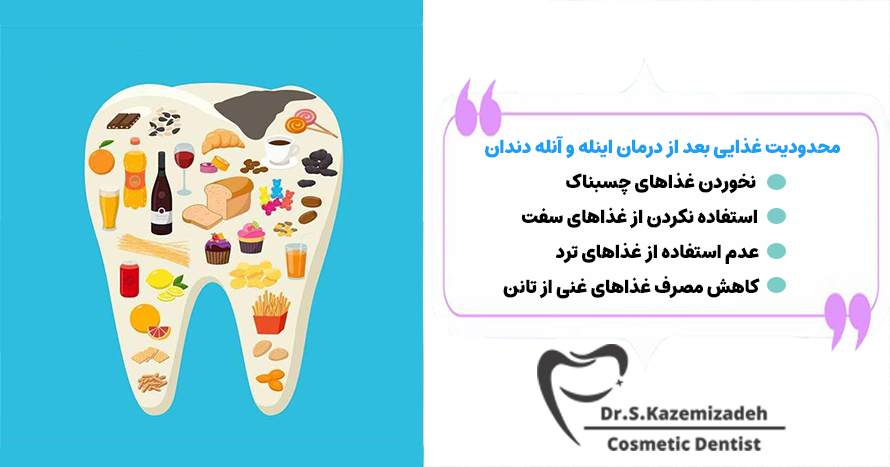 محدودیت غذایی برای اینله و آنله دندان | دکتر سپیده کاظمی زاده در اصفهان