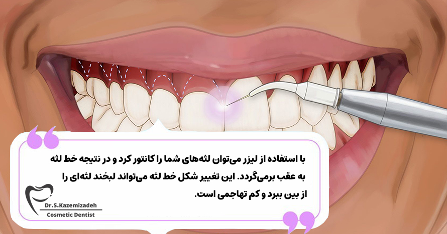 کانتورینگ لثه با لیزر | مطب دکتر سپیده کاظمی زاده