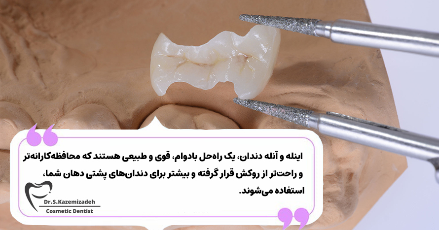 اینله و آنله دندان چیست؟ | مرکز دندانپزشکی دکتر سپیده کاظمی زاده در اصفهان