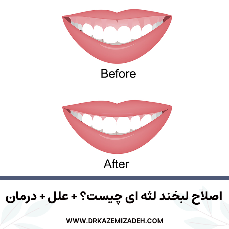اصلاح لبخند لثه ای چیست؟ + علل + درمان | دکتر سپیده کاظمی زاده
