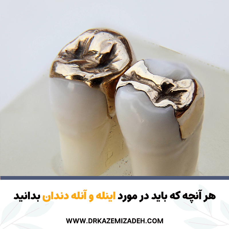 هر آنچه که باید در مورد اینله و آنله دندان بدانید | دکتر سپیده کاظمی زاده