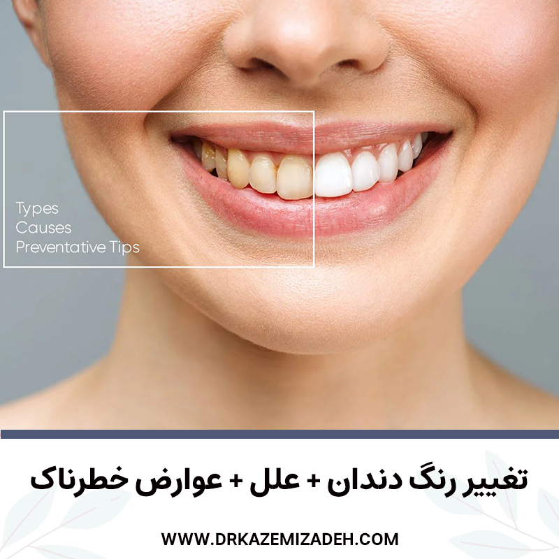 تغییر رنگ دندان + علل + عوارض خطرناک | دکتر سپیده کاظمی زاده