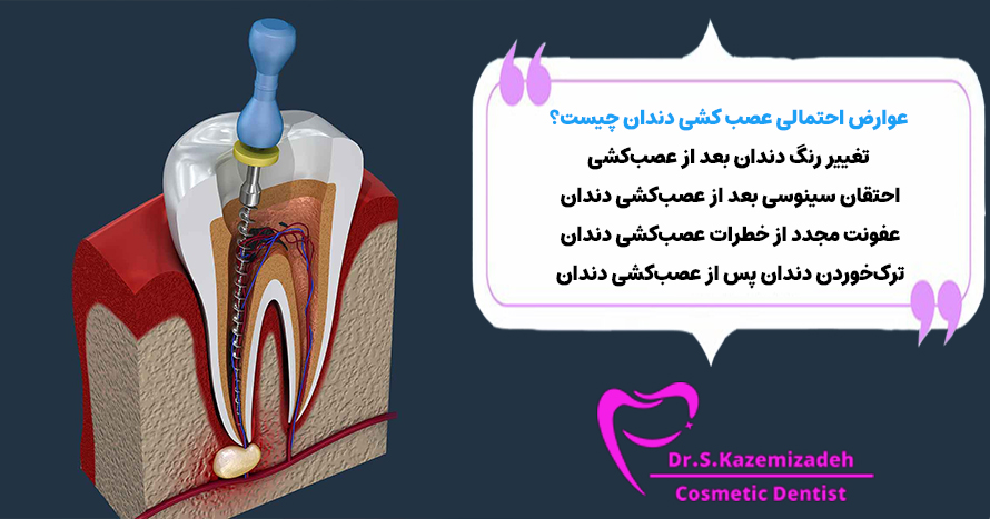 عوارض عصب کشی دندان | دکتر سپیده کاظمی زاده در اصفهان