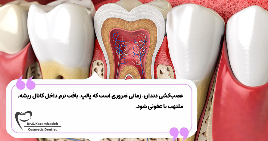 چگونه بفهمیم که آیا به عصب‌کشی دندان نیاز داریم؟ | دکتر سپیده کاظمی زاده در اصفهان