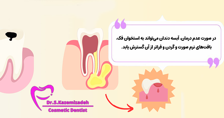 آبسه دندان چه تأثیری بر سلامت کلی دهان و دندان من دارد؟ | دکتر سپیده کاظمی زاده در اصفهان