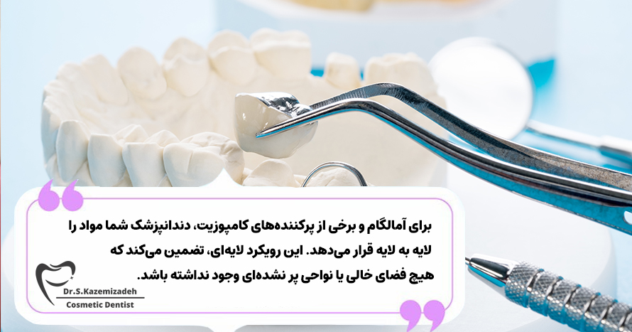 قراردادن مواد پرکننده دندان | دکتر سپیده کاظمی زاده در اصفهان