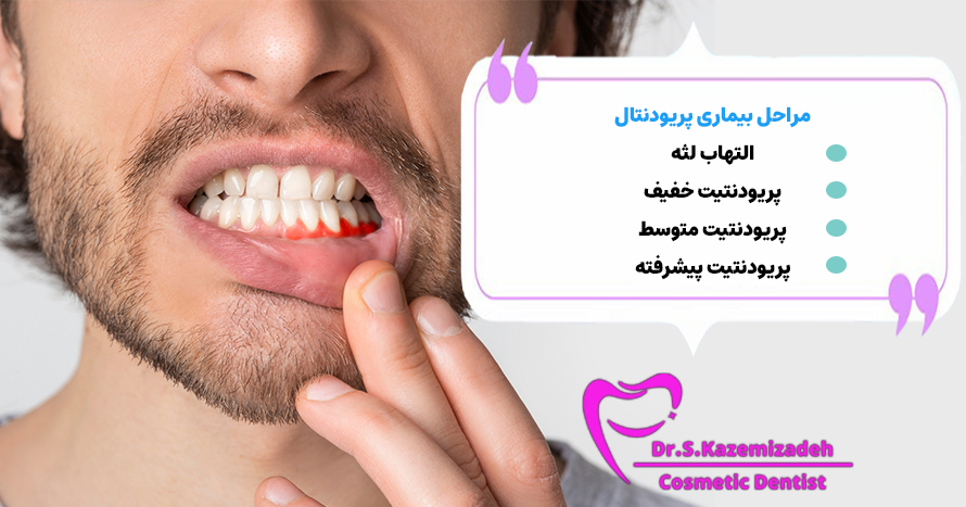 مراحل بیماری پریودنتال | دکتر سپیده کاظمی زاده در اصفهان