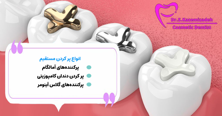 انواع پر کردن دندان مستقیم | دکتر سپیده کاظمی زاده در اصفهان