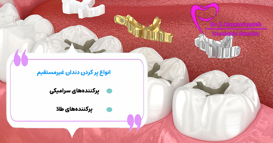  پر کردن دندان غیرمستقیم | دکتر سپیده کاظمی زاده در اصفهان