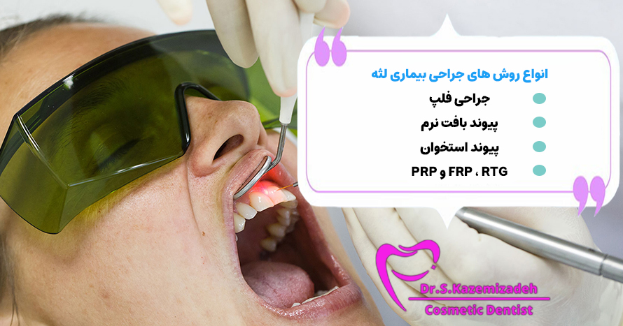 انواع روش های جراحی بیماری لثه | دکتر سپیده کاظمی زاده در اصفهان