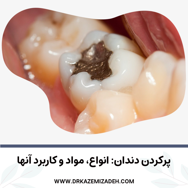 پرکردن دندان: انواع، مواد و کاربرد آنها | دکتر سپیده کاظمی زاده در اصفهان