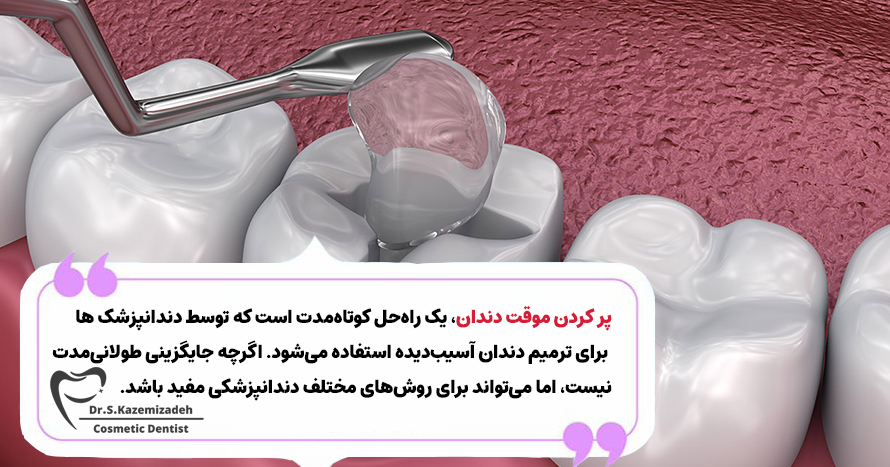 پر کردن موقت چیست؟ | دکتر سپیده کاظمی زاده در اصفهان