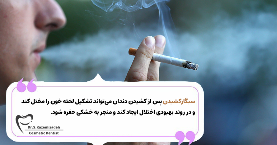 آیا فرد می‌تواند 24 ساعت پس از استخراج سیگار بکشد؟ | دکتر سپیده کاظمی زاده در اصفهان