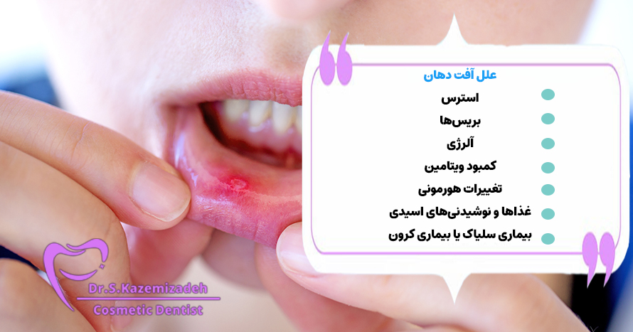 علت آفت دهان | بهترین متخصص دندانپزشکی اصفهان