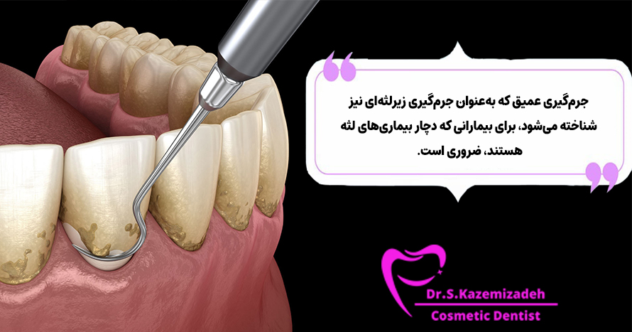 جرم‌گیری عمیق دندان | دکتر سپیده کاظمی زاده در اصفهان