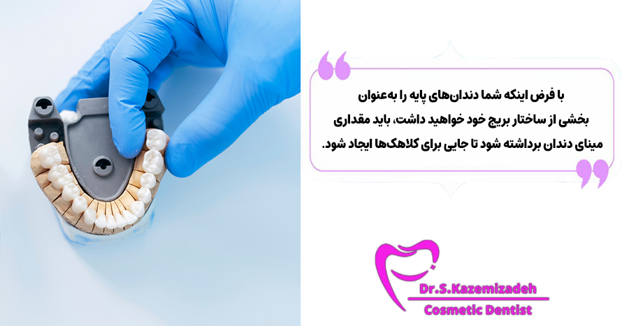 مراحل نصب بریج دندان | دکتر سپیده کاظمی زاده