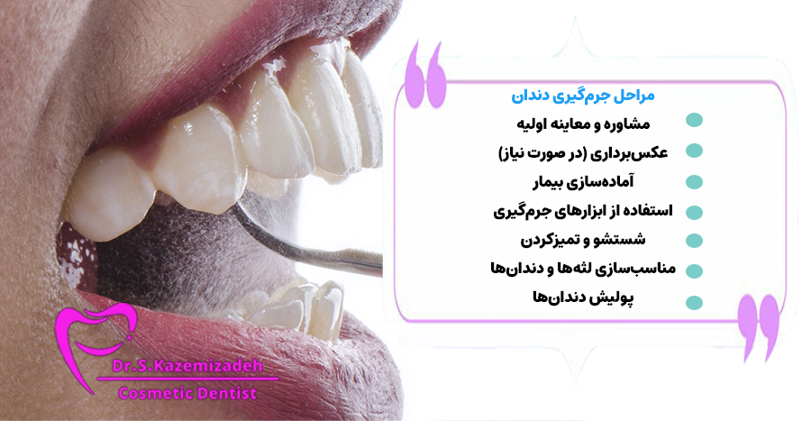 مراحل جرم گیری دندان | دکتر سپیده کاظمی زاده