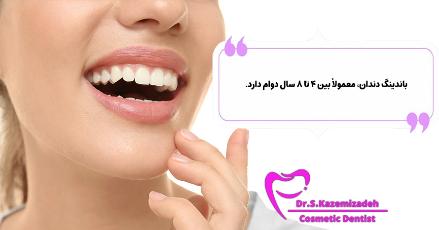 باندینگ دندان چقدر دوام دارد؟ | دکتر سپیده کاظمی زاده
