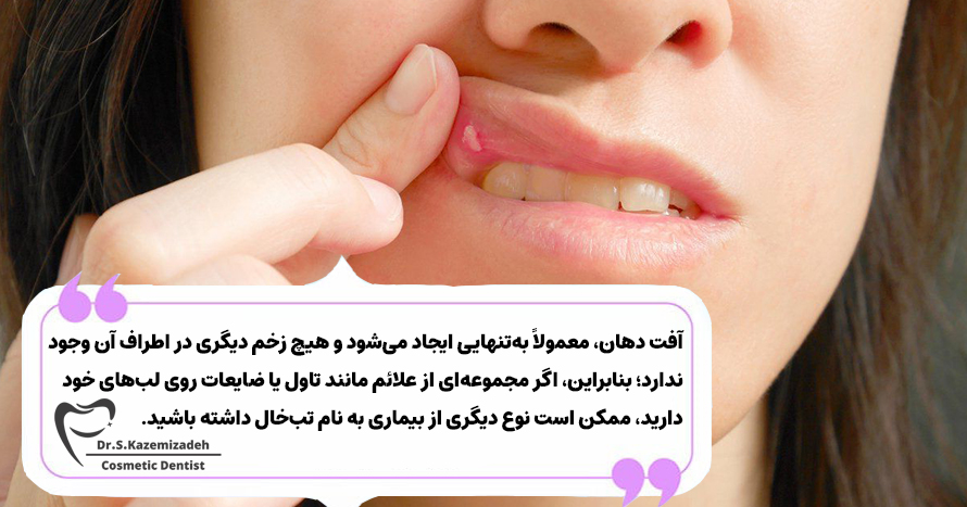 علائم آفت دهان (زخم شانکر) | دکتر سپیده کاظمی زاده در اصفهان