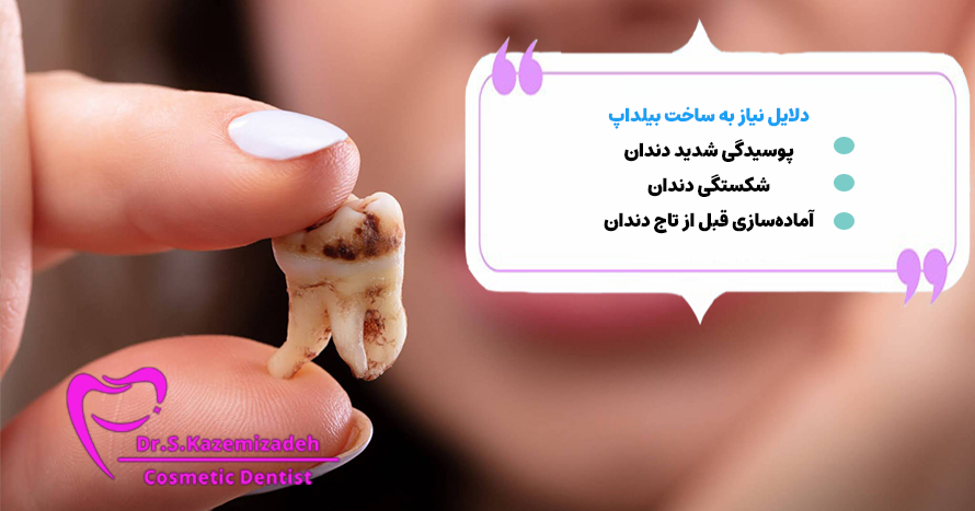 دلایل نیاز به ساخت بیلداپ دندان | دکتر سپیده کاظمی زاده در اصفهان