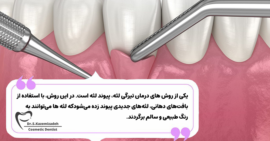 درمان تیرگی لثه | دکتر سپیده کاظمی زاده 