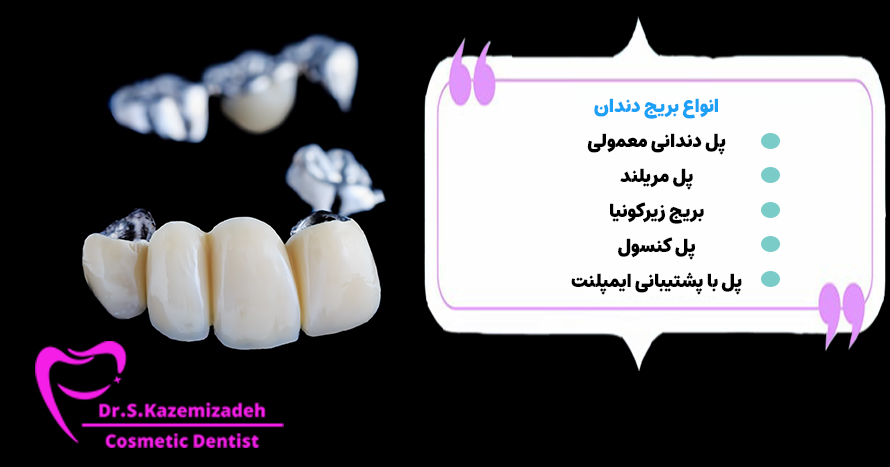 انواع بریج دندان | دکتر سپیده کاظمی زاده 