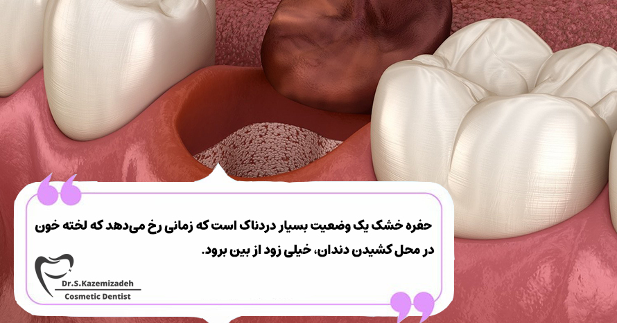سوکت خشک دندان چیست؟ | دکتر سپیده کاظمی زاده در اصفهان