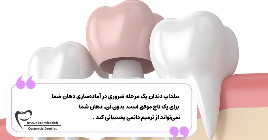 بیلداپ دندان چیست؟ | دکتر سپیده کاظمی زاده