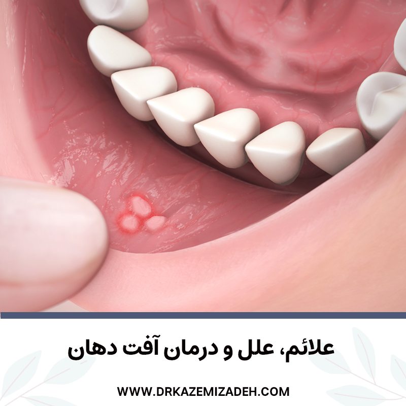 علائم، علل و درمان آفت دهان | دکتر سپیده کاظمی زاده در اصفهان