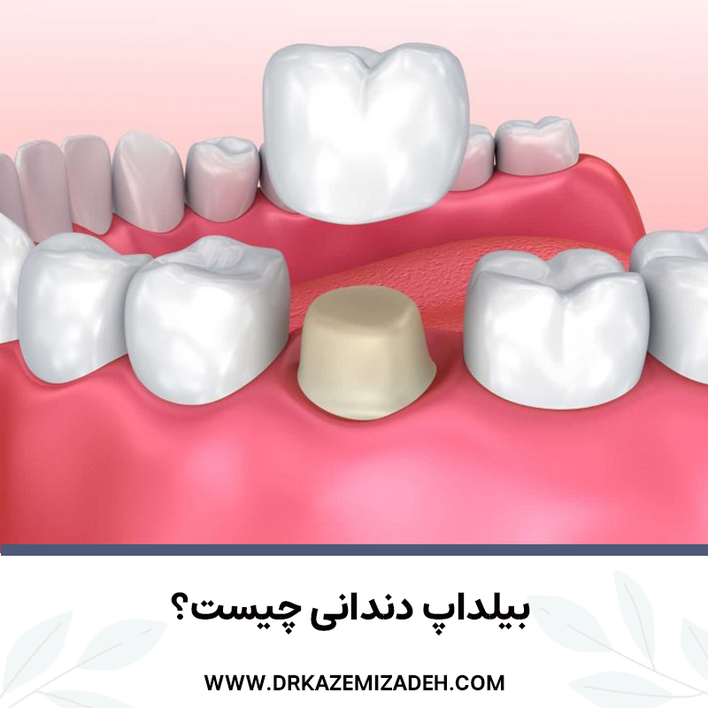 بیلداپ دندانی چیست؟ | دکتر سپیده کاظمی زاده در اصفهان