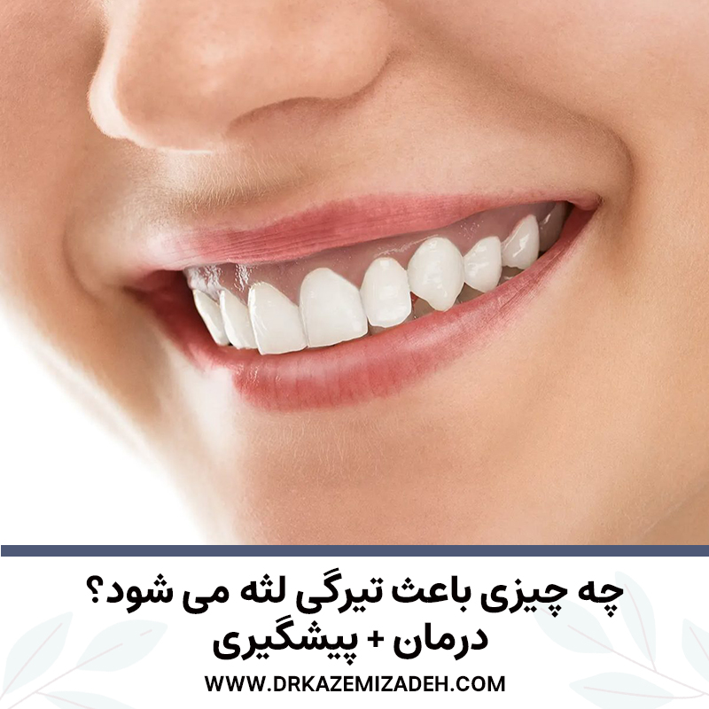 چه چیزی باعث تیرگی لثه می شود؟ درمان و پیشگیری | دکتر سپیده کاظمی زاده در اصفهان
