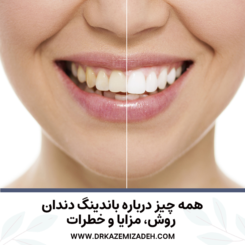 همه چیز درباره باندینگ دندان: روش، مزایا و خطرات | دکتر سپیده کاظمی زاده