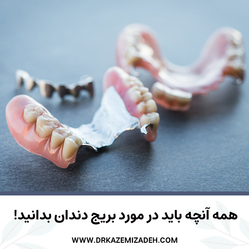 همه آنچه باید در مورد بریج دندان بدانید! |دکتر سپیده کاظمی زاده در اصفهان