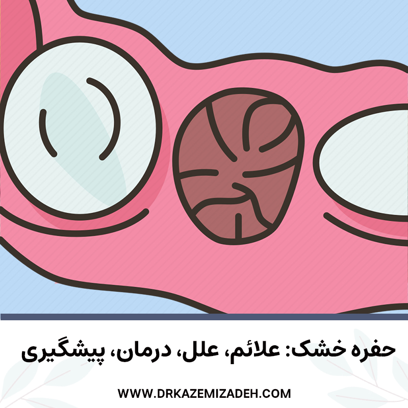 حفره خشک: علائم، علل، درمان، پیشگیری | دکتر سپیده کاظمی زاده