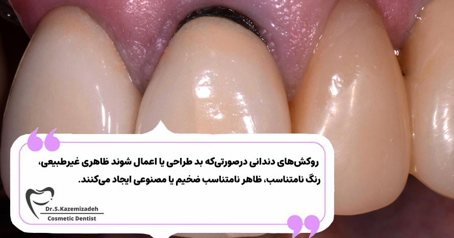 ظاهر بد از خطرات روکش دندان | بهترین دکتر کامپوزیت و لمینت دندان اصفهان