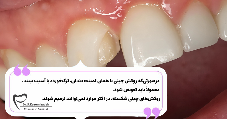آیا لمینتهای دندان میتوانند مادامالعمر دوام داشته باشند؟ | دکتر سپیده کاظمی زاده در اصفهان