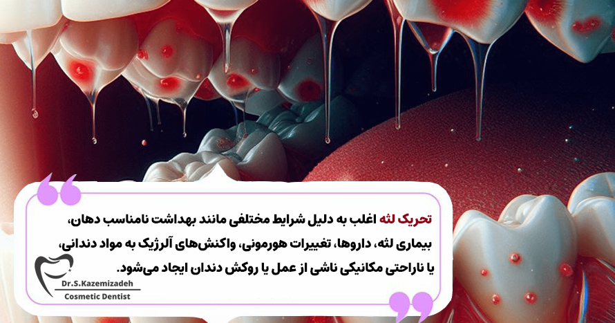 التهاب لثه، از عوارض جانبی روکش های دندانی | مطب دکتر سپیده کاظمی زاده در اصفهان