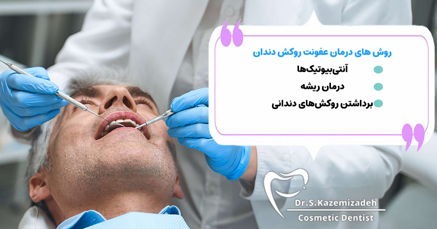 درمان عفونت بعد از روکش دندان | مطب دکتر سپیده کاظمی زاده